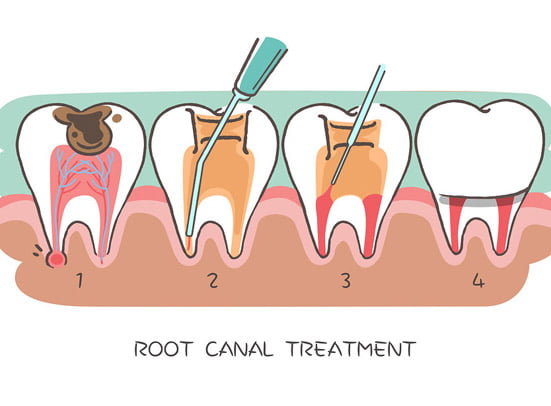 Root Canal: Procedure, What It Treats & Recovery