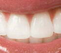 Whitening