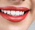 Veneers