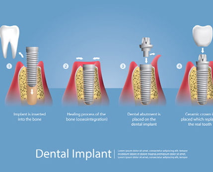 Should You Consider Dental Implants?