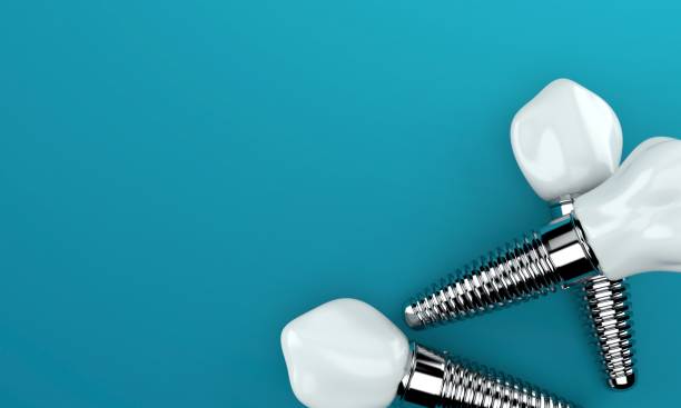 Important facts about dental implants