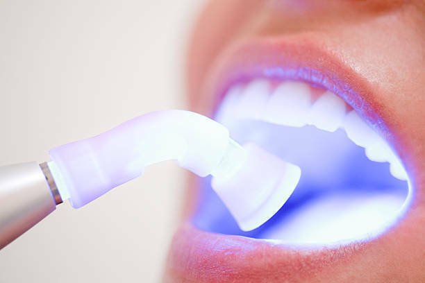 Teeth Chairside Bleaching