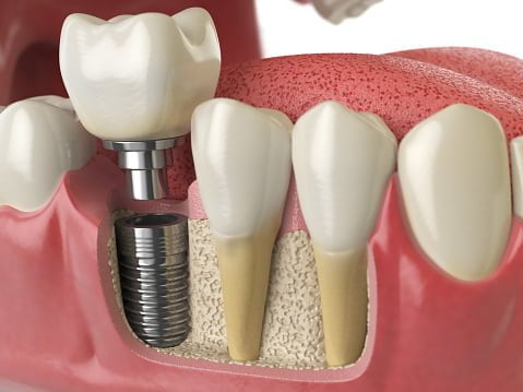 dental implant